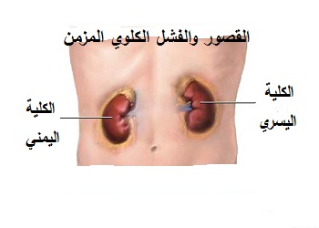 اعراض الكلى 20160808 1953