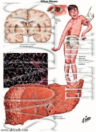اعراض مرض ويلسون 20160803 1604
