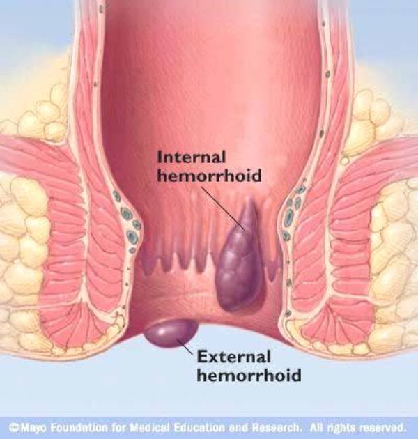  Photo R7_Hemorrhoids-Jpg