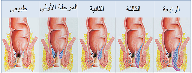 اعراض البواسير بالتفصيل الممل - ماهي اعراض البواسير درجات البواسير