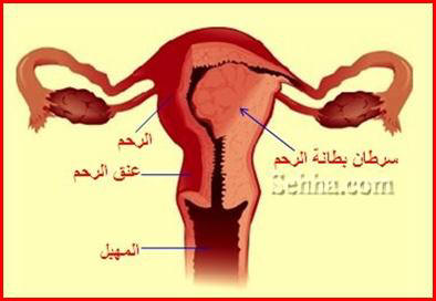سرطان الرحم 15642 2