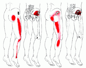 Sciatica-Tp_Min3 Copy