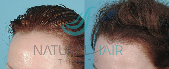 لتصغير القورة و كثافة الشعر تصغير لتصغير القورة و كثافة الشعر, تصغير الجبهة و انبات الشعر