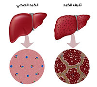 ما هو تليف الكبد