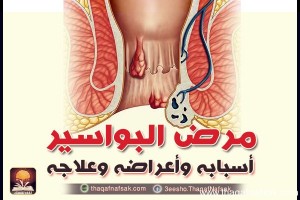 نواع البواسير , وانواعها وعلاجها