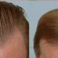 C4Aa0F9213Ce3269492Ea34104C2D298 الثوم في شعرى موقعش تاني خالص - علاج تساقط الشعر عند الرجال بالثوم حلمي جميل