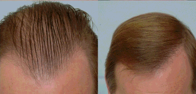 C4Aa0F9213Ce3269492Ea34104C2D298 الثوم في شعرى موقعش تاني خالص - علاج تساقط الشعر عند الرجال بالثوم خوله هذال