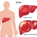 أعراض مرض الكبد اعراض امراض الكبد حلمي جميل