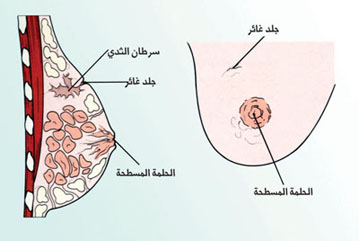 أعراض سرطان الثدي بالصور الحقيقية