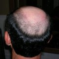 Male Pattern Baldness In Combination With Alopecia Areata الجنسنج و علاج الصلع عرفه حمدان